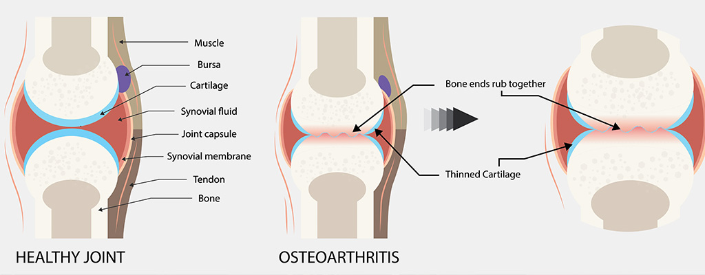 Find Relief from Osteoarthritis Pain